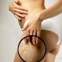 Лазерная шлифовка растяжек