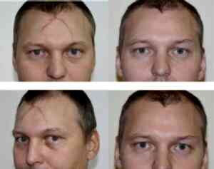 лазерная шлифовка рубцов в Алматы