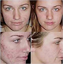 Лазерный пилинг в Алматы