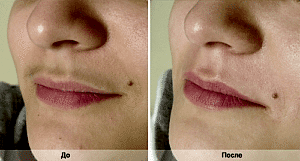 Лазерная эпиляция усиков в Алматы