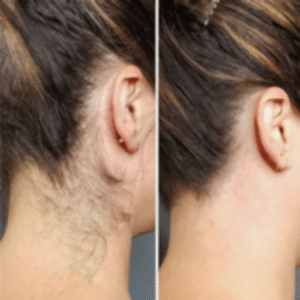 Лазерная эпиляция шеи