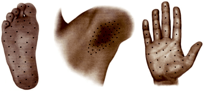 Лечение Гипергидроза в Алматы
