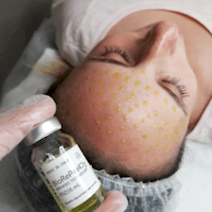 Биорепил пилинг