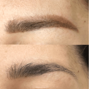 удаление татуажа лазером в Алматы