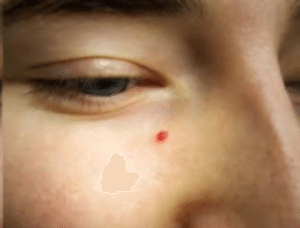 Удаление ангиом лазером