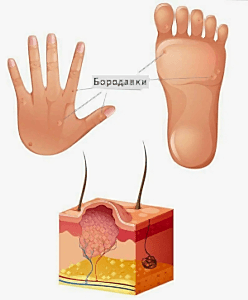удаление шипицы (удаление бородавок)