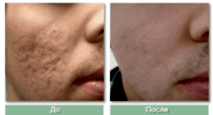 Лазерное удаление постакне