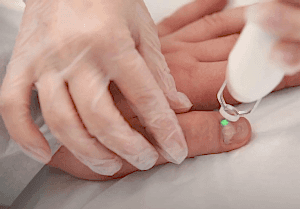 Лечение грибка ногтей лазером в Алматы